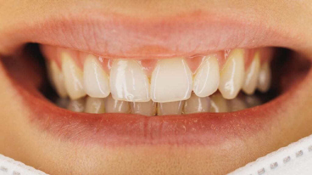 Repair Chipped Tooth Urgent: Steps to Save Your Smile Today
